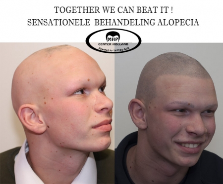 De oplossing haar pigmentatie ofwel micro hair pigmentatioe (MHP)Alopecia Areata is 1 van de bekendste vormen van Alopecia. Alopecia Areata begint vaak met grote of kale plekken op het hoofd. Deze kale plekken zijn vaak rond of ovaal van vorm.