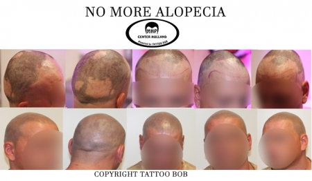 Alopecia zorgt voor kale plekken op het hoofd.
