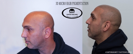 Scalp hair pigmentatio, by tattoo Bob.