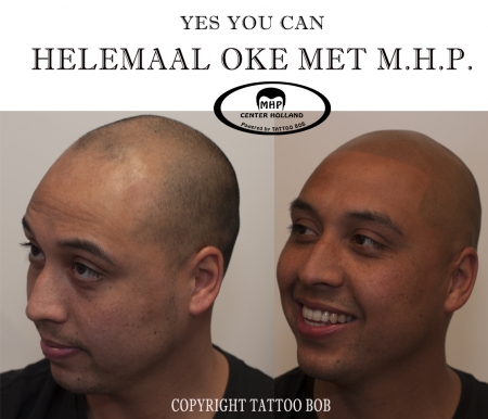 Krijg weer een mooie volle haarlook met de stoppeltatoeage van Tattoo bob.