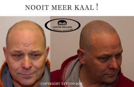 Zachte natuurlijke haarlijn. Micro haar pigmentatie is naar wens aan te brengen.