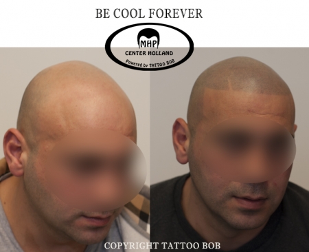 De micro haar pigmentatie techniek van Tattoo Bob zorgt voor een revolutionaire verandering van je uiterlijk.