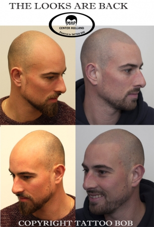 Scalp pigmentation tattoo Bob Rotterdam