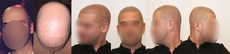 Deze man heeft eerst een haartransplantatie ondergaan. Dit heeft niet het gewenste resultaat gegeven. Hij heeft nu een compleet volle look terug gekregen. Dit is gerealiseerd door de microhaar pigmentatie behandeling.