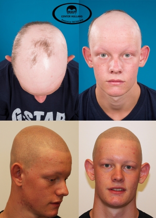 alopecia areata