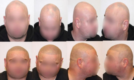 WAT IS ALOPECIA AREATA?