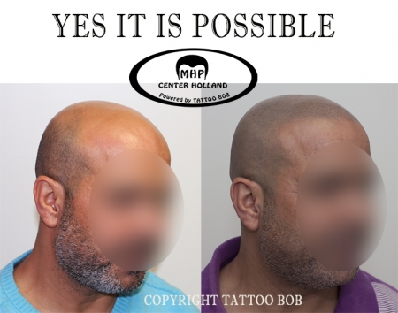 Krijg weer een mooie volle geschoren look door scalp pigmentation door tattoo bob Rotterdam.