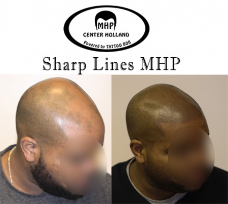 Micro Haar Pigmentatie is, met name in de Verenigde Staten, ook wel bekend als Scalp Micropigmentation (SMP) of Scalp Pigmentation. In Nederland zult u veel het woord of de term 