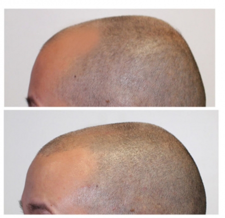 Inhammen opvullen met scalp pigmentation.