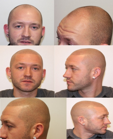 Micro hair pigmentation (MHP) is een uiterst specialisme. MHP is ook wel bekend als scalppigmentatie of haar pigmentatie en is een perfecte cosmetische oplossing voor mannen of vrouwen met kaalheid, alopecia, dun haar of die (veel) last hebben van haaruit